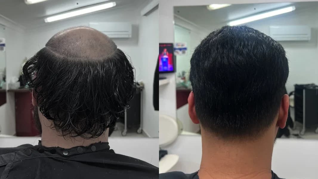 Back view of a Hair Crew client's before-and-after hair replacement results