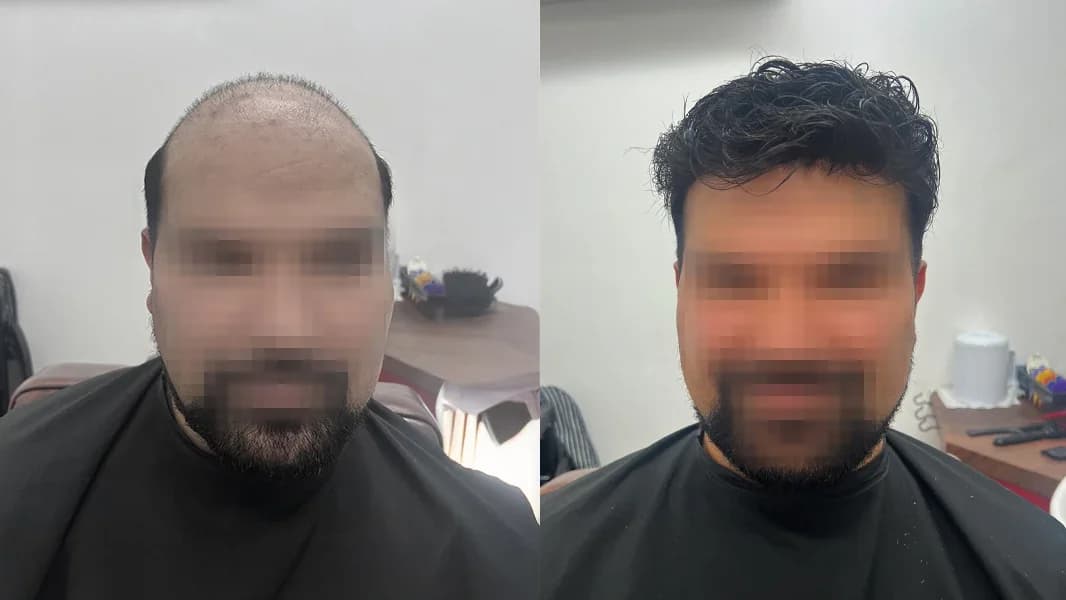 Front view of a Hair Crew client's before-and-after hair replacement results