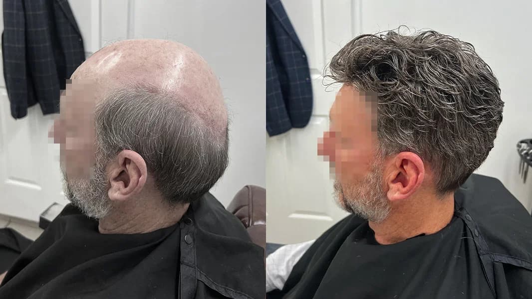 Side view of a Hair Crew client's before-and-after hair replacement results