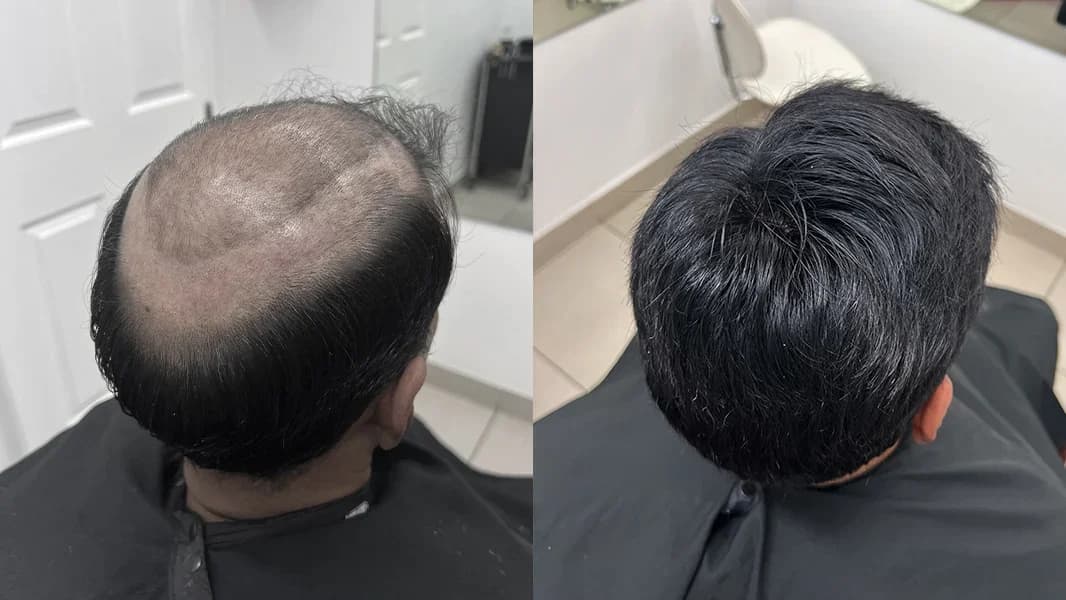 Top view of a Hair Crew client's before-and-after hair replacement results